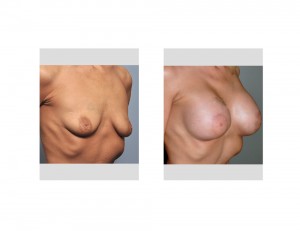 Stacey Norman Breast Augmentation results oblique view