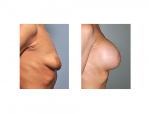 Stacey Norman Breast Augmentation results side view
