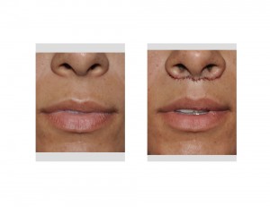 Subnasal Lip Lift immediate result front view