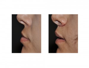 Subnasal Lip Lift immediate result side view