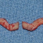 Subnasal Lip Lift skin segments removed Dr Barry Eppley Indianapolis