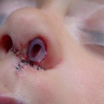 cleft rhinopalsty skin graft dr barry eppley indianapolis