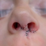 cleft rhinplasty columnellar skin graft dr barry eppley indianapolis