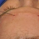 fat injections to brow bone dr barry eppley indianapolis