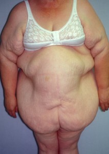 Abdominal Panniculectomy Indianapolis Dr Barry Eppley