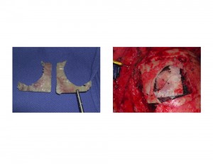Forehead Osteoma Bone Reconstruction Dr Barry Eppley Indianapolis