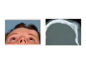 Forehead Osteoma Dr Barry Eppley Indianapolis