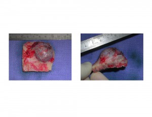 Forehead Osteoma Excision Dr Barry Eppley Indianapolis