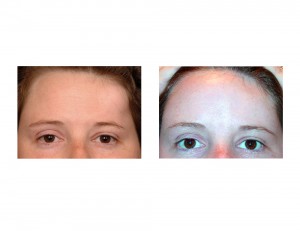 Forehead Osteoma Reconstruction result front view Dr Barry Eppley Indianapolis