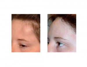 Forehead Osteoma Reconstruction result left oblique view Dr Barry Eppley Indianapolis