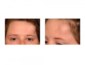 Forehead Osteoma closeup Dr Barry Eppley Indianapolis