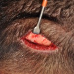 Nuchal Ridge Reduction burring technique Dr Barry Eppley Indianapolis intraop