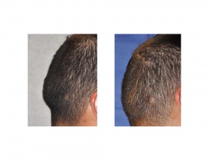 Nuchal Ridge Reduction result Dr Barry Eppley Indianapolis