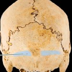Nuchal Skull Ridges