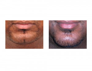 Obstructive Sleep Apnea Sliding Genioplasty result front view Dr Barry Eppley Indianapolis