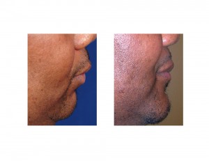 Obstructive Sleep Apnea Sliding Genioplasty result sidew view Dr Barry Eppley Indianapolis