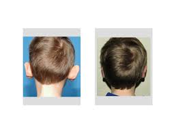 Otoplasty for Protruding Ears Indianapolis Dr Barry Eppley
