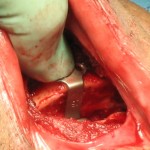 Sliding Genioplasty Technique for Obstructive Sleep Apnea Dr Barry Eppley Indianapolis