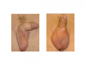 Testicular Implant results Dr Barry Eppley Indianapolis