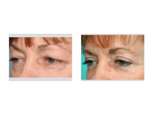 Upper and Lower Blepharoplasty result oblique view Dr Barry Eppley Indianapolis