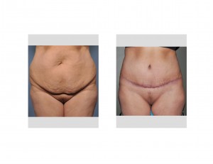 Urinary Incontinence and Tummy Tuck Surgery Dr Barry Eppley Inianapolis