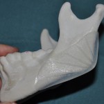 Vertical Lengthening Jaw Angle Implants Indianapolis Dr Barry Eppley