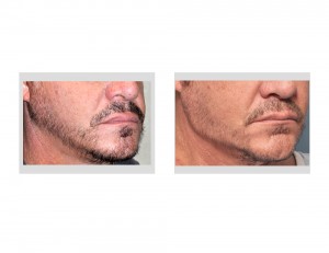 Vertical Lengthening Jaw Angle Implants result oblique view Dr Barry Eppley Indianapolis