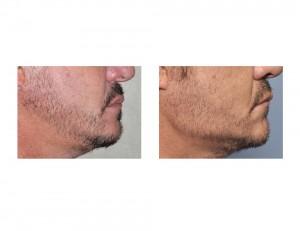 Vertical Lengthening Jaw Angle Implants result side view Dr Barry Eppley Indianapolis