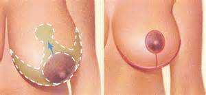 Wise Pattern Breast Reduction Dr Barry Eppley Indianapolis