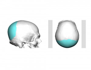 Custom Occipital Imp[lant Design Dr Barry Eppley Indianapolis