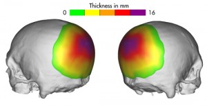 Custom Occipital Implant design thickness Dr Barry Eppley Indianapolis