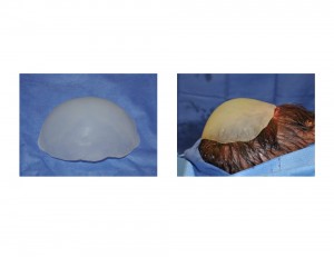 Custom Occipital Implant intraop Dr Barry Eppley Indianapolis