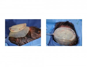 Custom Occipital Implant with Tissue Expansion Dr Barry Eppley Indianapolis