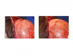 Forehead Augmentation with Hydroxyapatite Cement intraop Dr Barry Eppley Indianapolis
