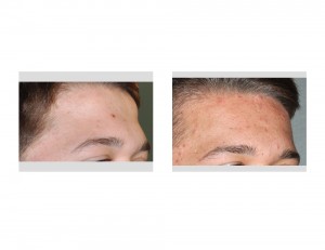 Forehead Recontouring result oblique view