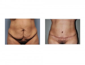 Hispanic Tummy Tuck result front view
