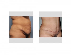 Hispanic Tummy Tuck result oblique view