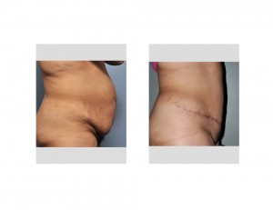 Hispanic Tummy Tuck result side view