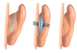 Otoplasty for protruding ears Dr Barry Eppley Indianapolis