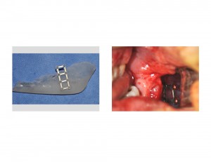 Plate Fixation Jaw Angle Implant Dr Barry Eppley Indianapolis