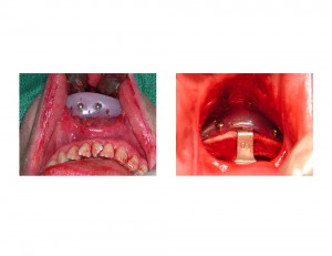 Sliding Genioplasty and Chin Implant Dr Barry Eppley Indianapolis