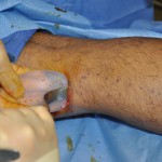 Calf Implant Surgical technique Dr Barry Eppley Indianapolis