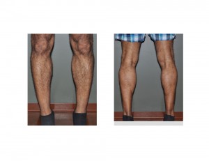 Calf Implant results toes raised Dr Barry Eppley Indianapolis