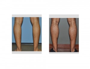 Calf Implants result back view Dr Barry Eppley Indianapolis