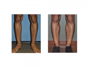 Calf Implants result front view Dr Barry Eppley Indianapolis