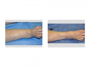 CankleLiposuction Dr Barry Eppley Indianapolis
