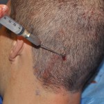 Fat Injections Neck Dr Barry Eppley Indianapolis