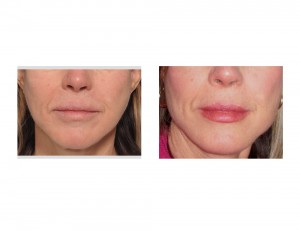 Female Jaw Angle Implant results front view Dr Barry Eppley Indianapolis