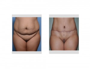 HH Tummy Tuck results front view