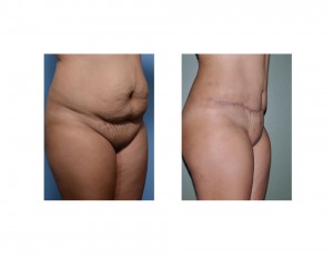 HH Tummy Tuck results oblique view